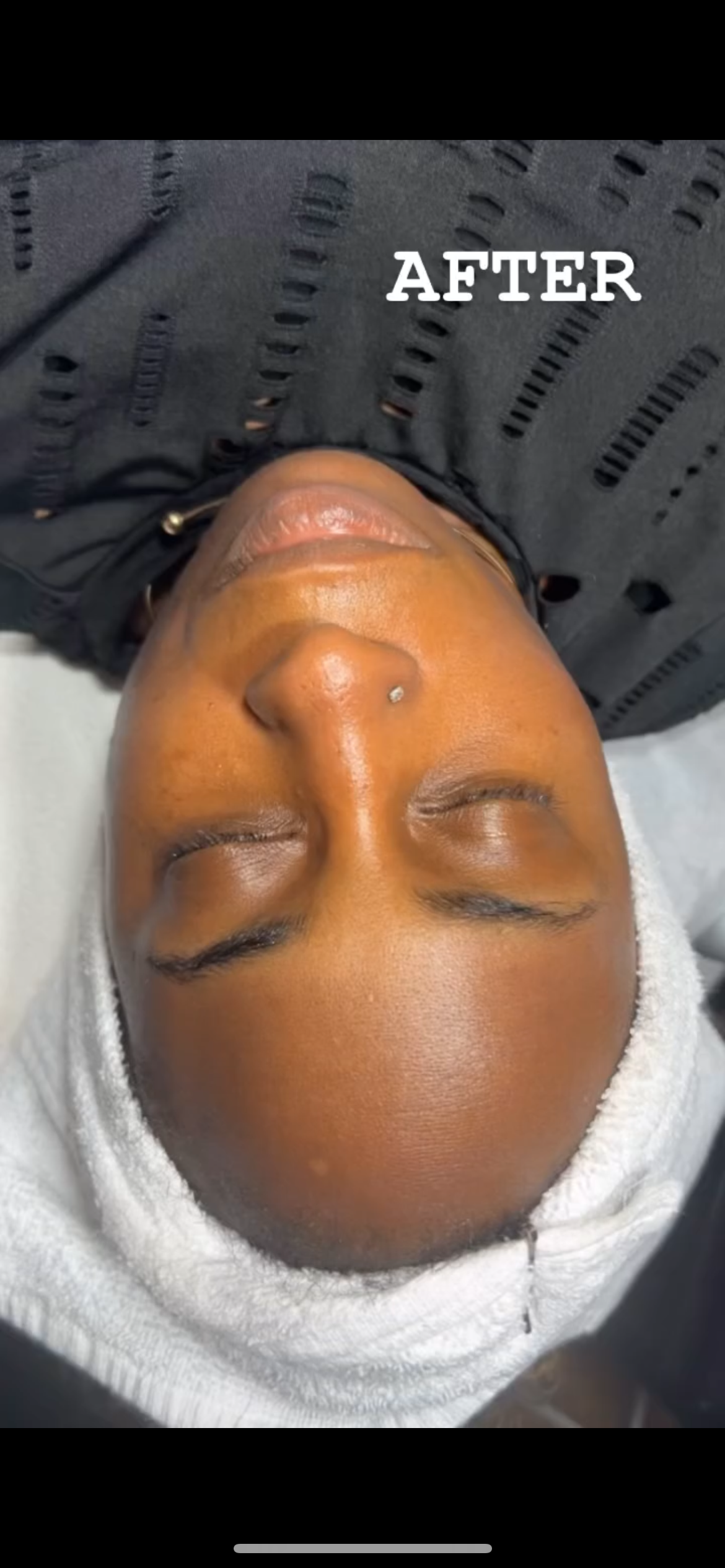 Amazing Microdermabrasion