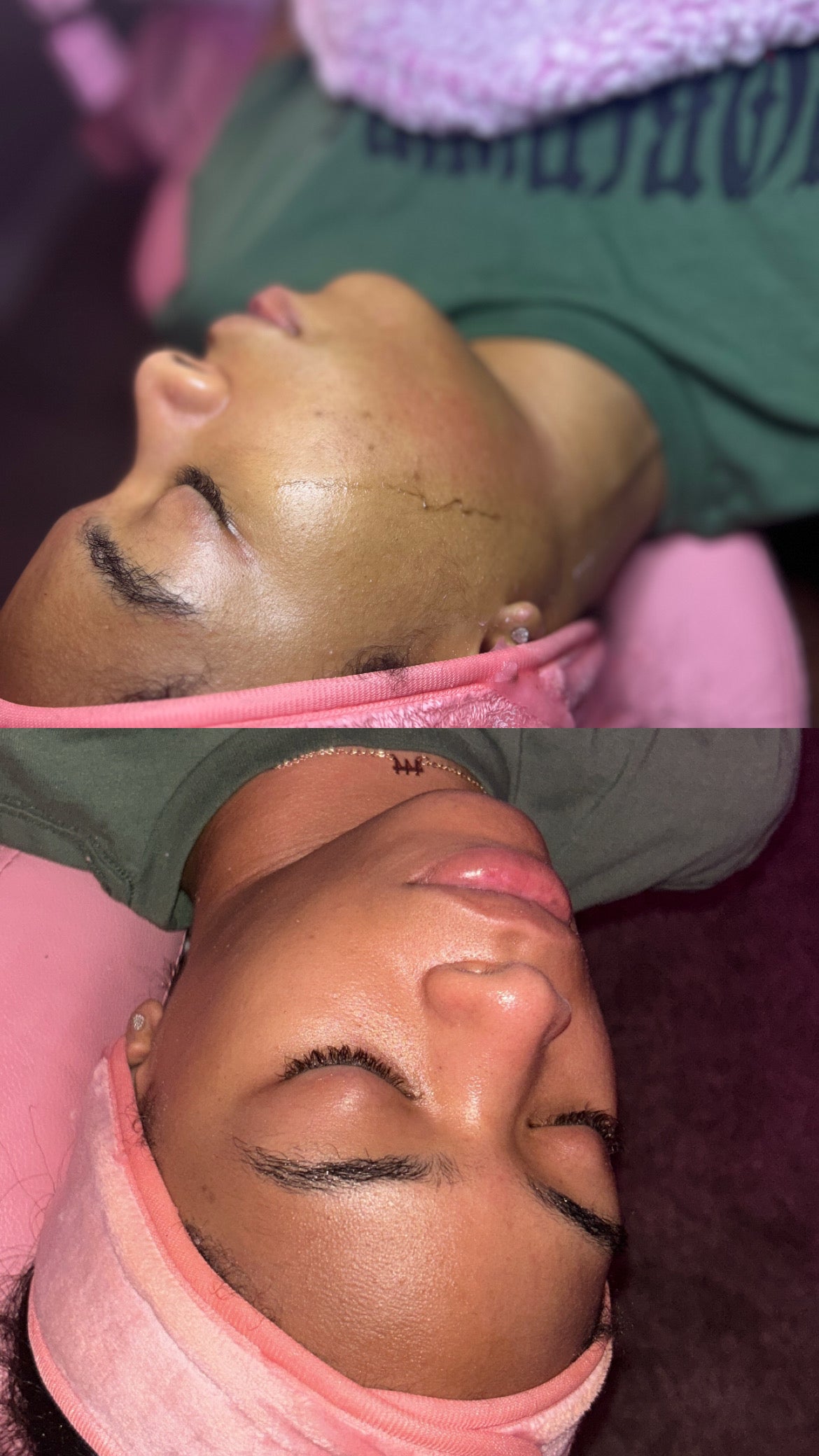 The Amazing glow | Dermaplanning Facial